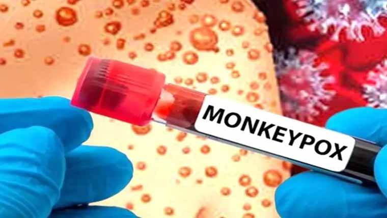  نشتر ہسپتال :زیر علاج مریض  میں منکی پاکس کی تصدیق