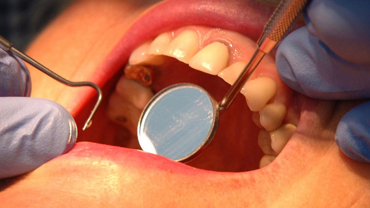 منہ کی صفائی میں مسوڑھوں کی صحت کو نظر انداز نہ کریں