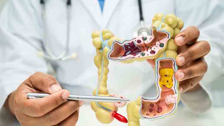 آنتوں کے زہریلے بیکٹیریا کا بڑی آنت کے کینسر سے تعلق 