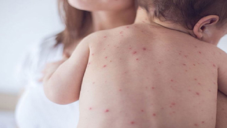 خسرہ سے بچاؤکی درخواست، سیکرٹری  صحت ذاتی حیثیت میں طلب