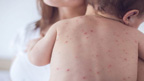 خسرہ سے بچاؤکی درخواست، سیکرٹری  صحت ذاتی حیثیت میں طلب