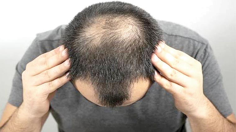 ماہرین نے گنج پن کا آسان اور مؤثر علاج دریافت کرلیا