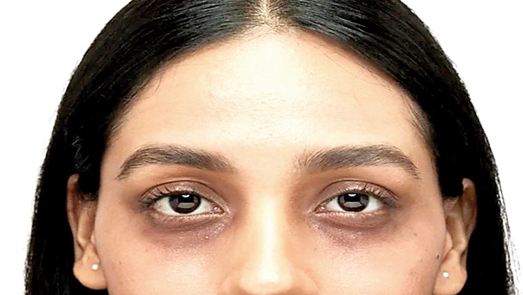 آنکھوں کے نیچے سیاہ حلقے کم کرنے کے آسان گھریلو طریقے