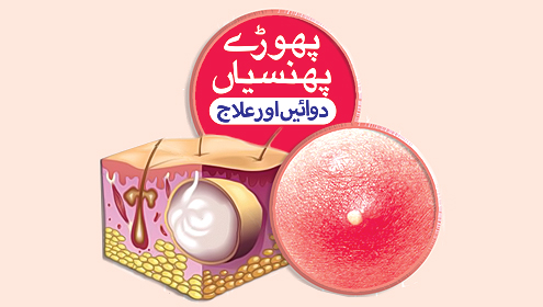 پھوڑے پھنسیاں  دوائیں اور علاج