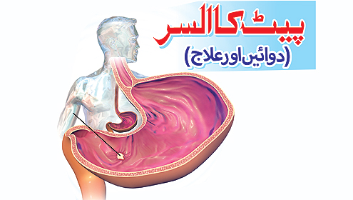  پیٹ کا السر (دوائیں اور علاج )