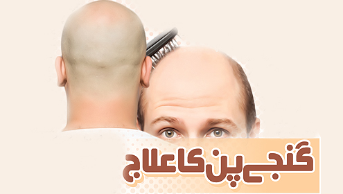 گنجے پن کا علاج