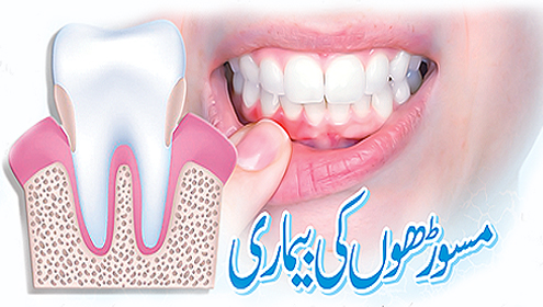 مسوڑھوں کی بیماری