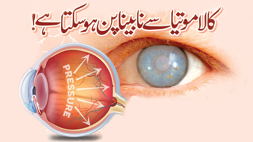 کالا موتیا سے نابینا پن ہو سکتا ہے!