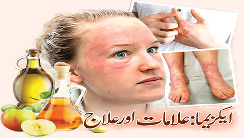 ایکزیما: علامات اور علاج